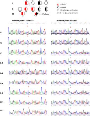 Identification of Novel Compound Heterozygous Variants of MMP9 in Fetus With Metaphyseal Anadysplasia Type 2
